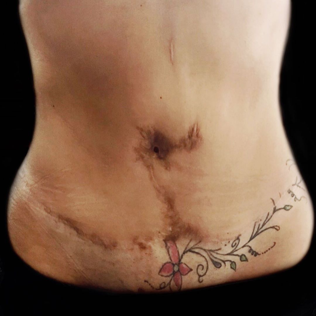 Robotic Hysterectomy Scar Cover Up Tattoo | TikTok