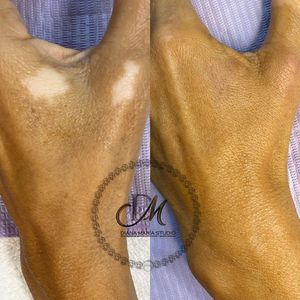 Vitiligo camouflage tattoo to hide depigmentation by Diana Maria Estudio #DianaMariaEstudio  #paramedicaltattoos #cosmetictattooing #Vitiligo #camouflagetattoos #restorativetattooing