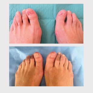Toenail restoration tattoo before and after from “Medical tattooing, the new frontiers” in Ann Ist Super Sanita, 2017 #paramedicaltattoos #restorativetattooing #cosmetictattooing