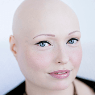 Brenda Finn, a model and alopecia awareness influencer, shows off her eyebrow tattoos. #BrendaFinn #cosmetictattooing #paramedicaltattoos #permanentmakeup #eyebrowtattoo