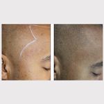Scalp micropigmentation for male balding – courtesy of the Dermatography Clinic #paramedicaltattooing #micropigmentation #restorativetattooing #camouflagetattoos #cosmetictattoos