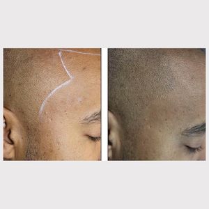Scalp micropigmentation for male balding – courtesy of the Dermatography Clinic #paramedicaltattooing #micropigmentation #restorativetattooing #camouflagetattoos #cosmetictattoos