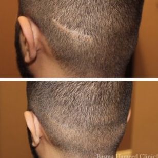 Scar camouflaged by paramedical tattoo by Basma Hameed Clinic #BasmaHameed #paramedicaltattoos #cosmetictattooing #permanentmakeup #scalpmicropigmentation #scarcoverup