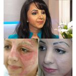 Basma Hameed before and after her facial tattoo treatment #BasmaHameed #paramedicaltattoos #cosmetictattooing #camouflagetattoo #permanentmakeup #scarcoverup #facialtattoos