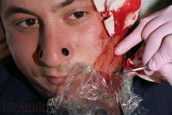 Face scarification