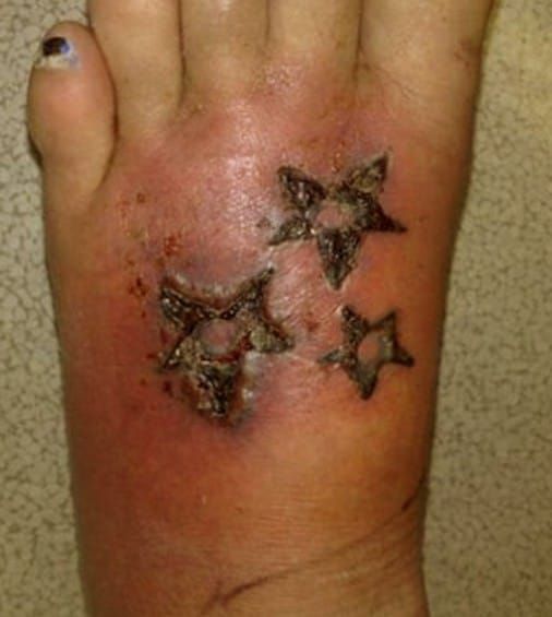 Tattoo infection
