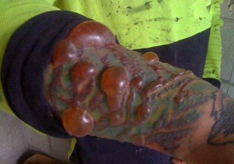 Tattoo infection