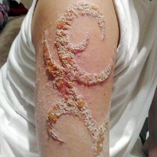 Common Tattoo Infections: Suing for Infections Caused by Tattoos