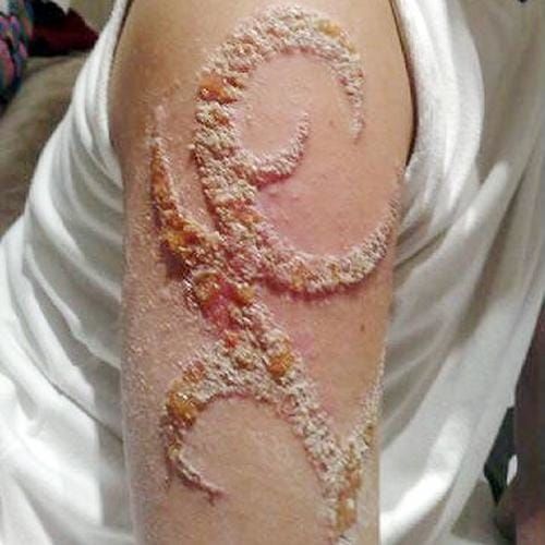 Tattoo infection