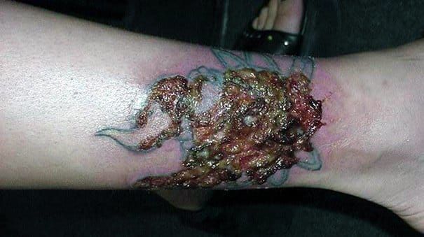 Tattoo infection