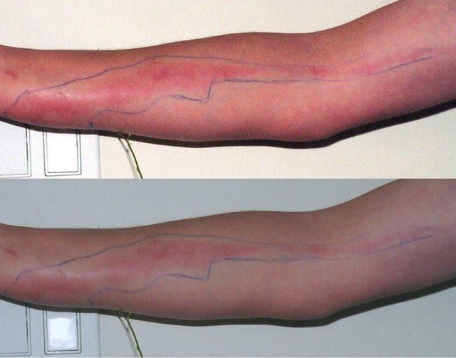 Tattoo infection symptom
