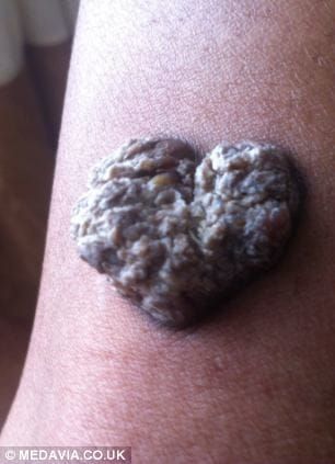 Tattoo infection symptom