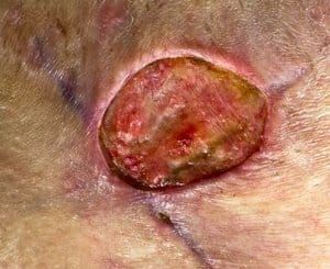 Tattoo infection symptom