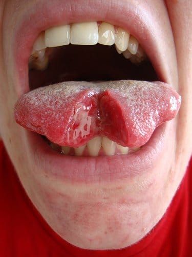 Tongue Splitting