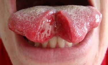 Extreme Body Modification: Tongue Splitting (Warning: Graphic content)