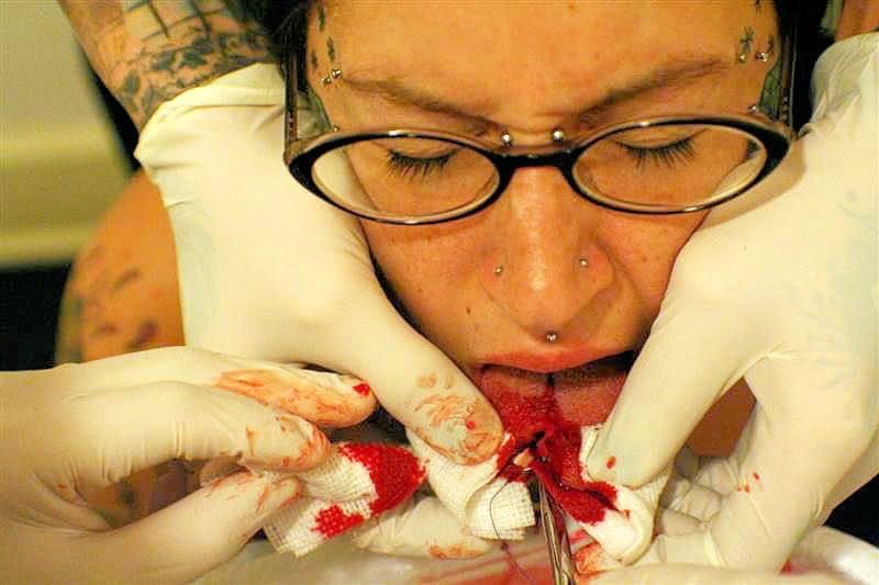 Tongue Splitting Procedure