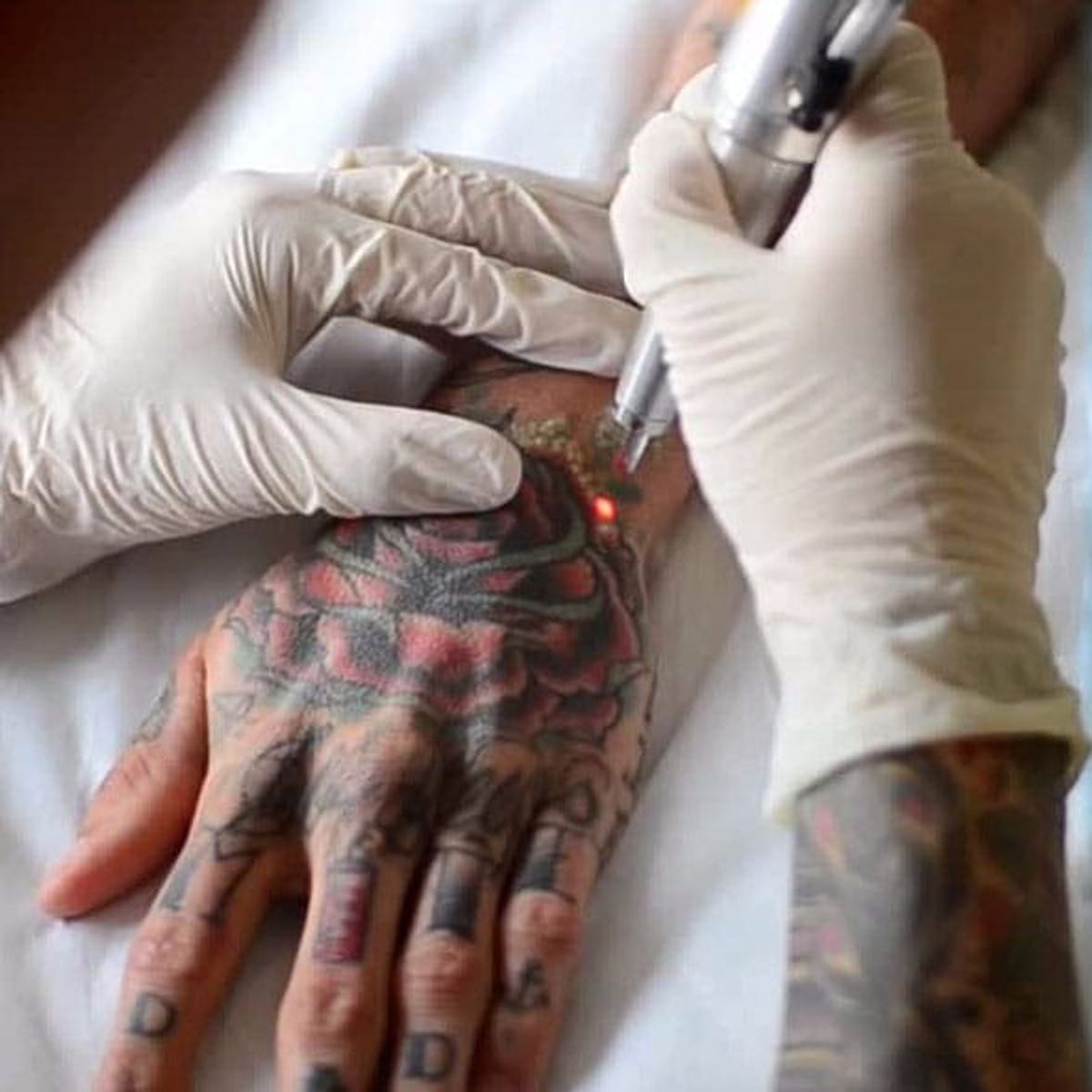 Cosmetologista removendo tatuagem com dispositivo a laser conceito de mão  feminina de apagar tatuagens como