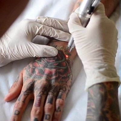 Dermatologia e Tatuagem: Como Funciona a Remoção De Tattoo à Laser