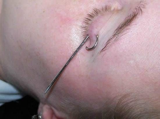 Getting an eyelid piercing
