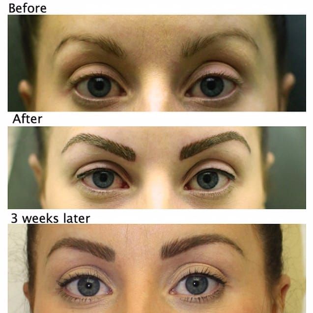 Eyeliner Tattoo Removal  How to Remove Permanent Eyeliner