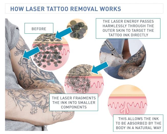 The Science Behind Laser Tattoo Removal: How It Works • Tattoodo