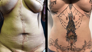 Abdominoplasty breast lift scar mask transformation by Damm Nice