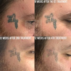 Tattoo artist Rocky Burley gets tattoo removal by Bethany of Clean Canvas More Art #CleanCanvasMoreArt #lasertattooremoval #tattooremoval