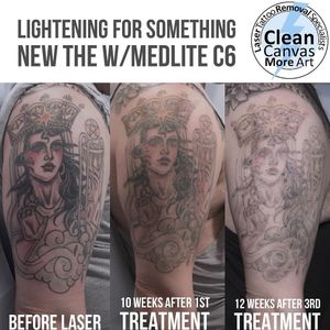 Clean Canvas More Art #CleanCanvasMoreArt #lasertattooremoval #tattooremoval