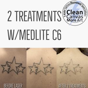Clean Canvas More Art #CleanCanvasMoreArt #lasertattooremoval #tattooremoval