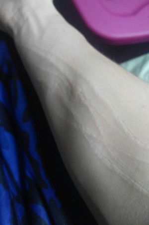 Is it possible to get these stupid scars covered there like 5 years old