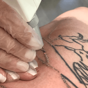 Remoção de Tattoo 