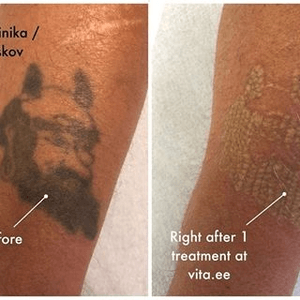 Tattoo by Vitaclinika. Tattoo removal