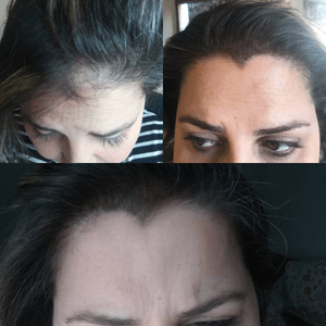 Hair pigmentation, scalp pigmentation, saç simülasyonu.