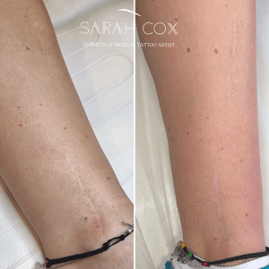 MCA (multi-trepannic collagen actuation) work on surgery scars. A definite improvement after only one session. The scar is flattened and pigment naturally returns. A course of MCA is usually the first step before Camouflage Tattooing