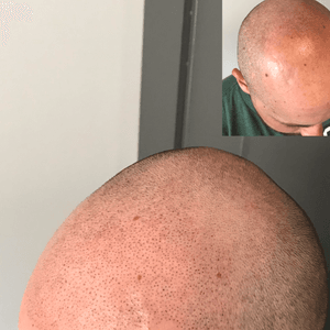 Second session of Scalp Micropigmentation. Starting to com together.
Check out www.instagram.com/scalp_envy_smp