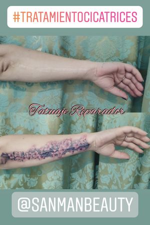 Tatuaje reparador de Cicatrices y cover up