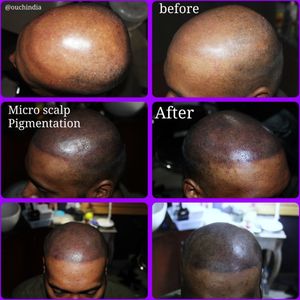 Micro scalp pigmentation tattoo at OUCH.                                                                   For bookings call at 7382521886, 9848597806