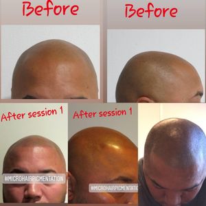 Micro hair pigmentation Razor shave pigmented The best alternative if hair transplantation is no option. Please Comment below. if you like our work!! Tell us your thoughts below or ask any questions. For info or appointments dm or +31626120203 ————————————— . . . . . #newpost #tat2holics #tattoo #tattooart #tattoogirls #tattooaddict #tattooartist #tattoodesign #tattoofineline #tattoolife #tattoostudio #denhaag #tattoomag #tattooguestspot #tattoomagazine #finelinetattoo #tattoodrawings #realism #tattooblackandgrey #finelinefloraltattoo #eternal #kwadron #ink #blackandgrey #tattoowork #tattooink #hiptattoo #tattoolover #girltattoo #tattooportait