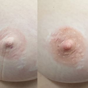 Before and after of a very delicate restorative 3D areola/nipple tattoo on a breast cancer survivor