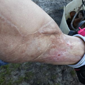 Scar tissue on lower left calf