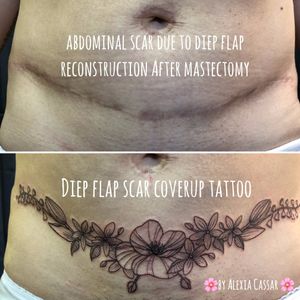 #Abdominal #scarcoverup #tattoo after #mastectomy by #AlexiaCassar #thetétonstattooshop #France #MarlylaVille #Nice #cancer #survivor