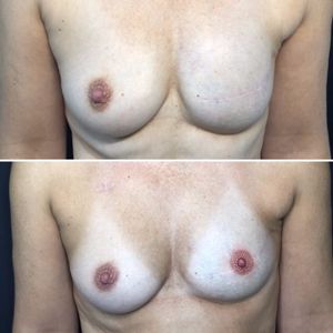 #3D #nippletattoo after #mastectomy by #AlexiaCassar #thetétonstattooshop #France #MarlylaVille #Nice #cancer #survivor