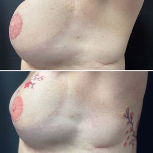 #3D #nippletattoo #rescue and #scarcoveruptattoo after #mastectomy by #AlexiaCassar #thetétonstattooshop #France #MarlylaVille #Nice #cancer #survivor