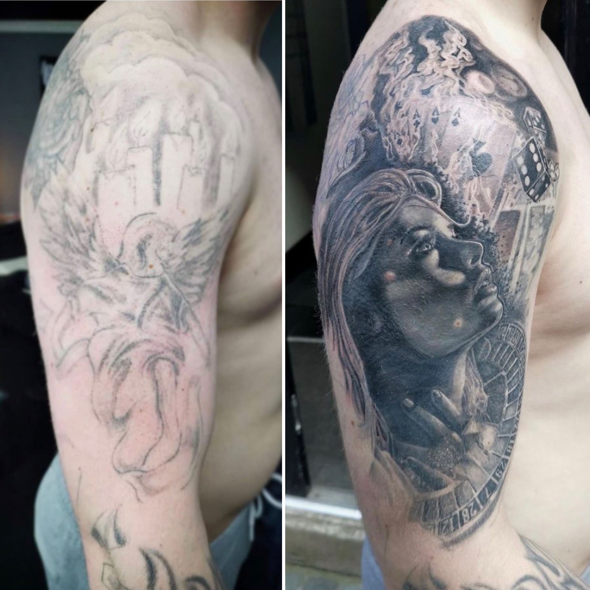 Laser Tattoo Removal Progress Photos