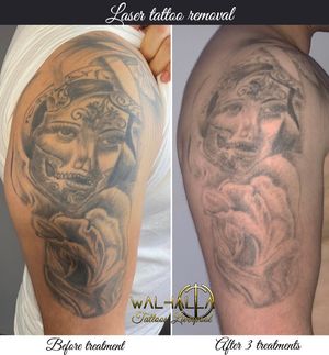 Laser tattoo removal available!