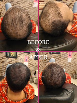 NO PAIN GREAT GAIN 👨..#scalpmicropigmentation #smp #hairloss #scalptattoo #hairtattoo #hairlosssolution #hairlosstreatment #microblading #hairtransplant #micropigmentation #thinninghair #scalppigmentation #alopecia #hairlinetattoo #hairline #permanentmakeup #pmu #scalp #madhulikaupadhyay #hairrestoration #bald #madhulika #hair #scalpmicropigmentationtraining #hairlosshelp #scarcamouflage #scalptattooing #cosmetictattoo #beauty #bhfyp