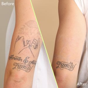 Tattoo by NAAMA -Tattoo Removal