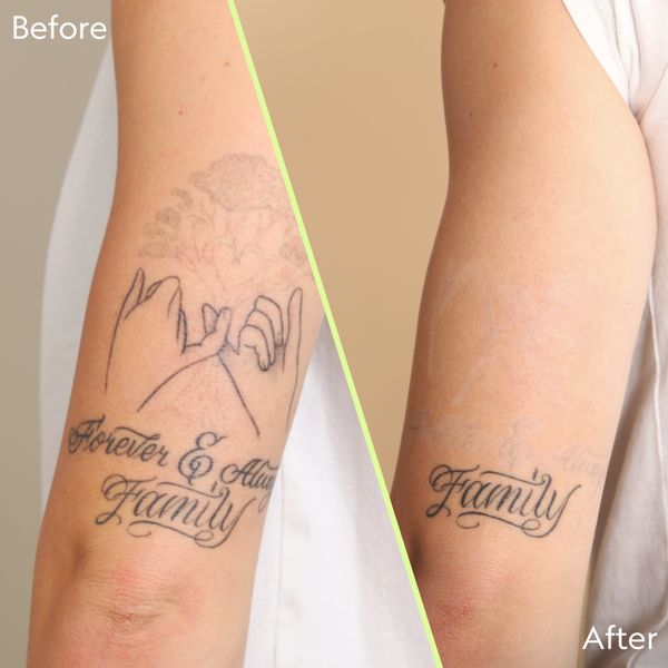 Tattoo from NAAMA -Tattoo Removal