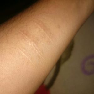 Can anyone suggest me a cover up for this scar