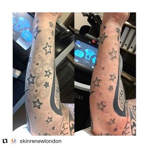 Straight after my Picosure tattoo removal. Shading gone in one hit. #skinrenewlondon #comingsoon #picosurelaser #picosuretattooremoval #tattoo #tattoos #tattooremoval #lasertattooremoval #laser #picosure #essex #tattooremovalessex #london #tattooremovallondon #tattoocoverup #tattooed #tattooart #tattoolife #tattooink #tattoodesign #tattooartist #londontattoo #tattooist #beforeandafter Skinrenewlondon.co.uk Check out the site and book in for free consultation and patch test.... 20% off your 1st treatment.